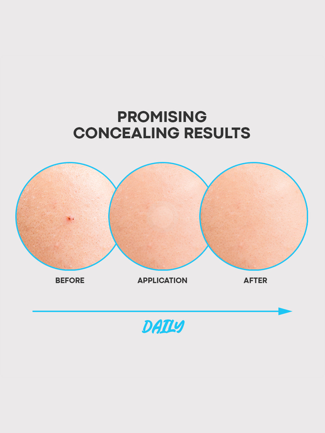 NOLAHOUR Spot Eraser Blue (Acne Patch) 63 Patches